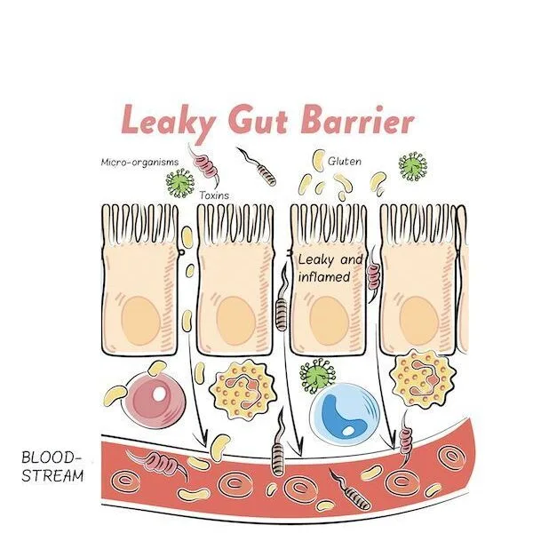 Sindrom Usus Bocor : Punca, Simptom & Cara Mengatasinya Secara Semula Jadi